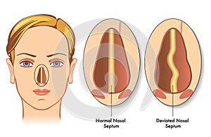 Deviated nasal septum