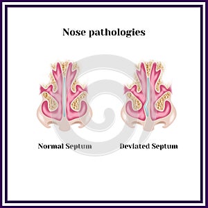 Deviated septum. Nasal pathology.