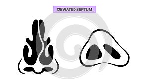 Deviated septum poster