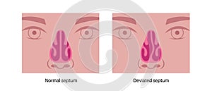 Deviated septum poster