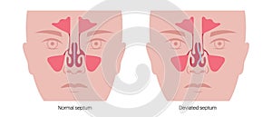 Deviated septum poster