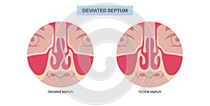 Deviated septum poster