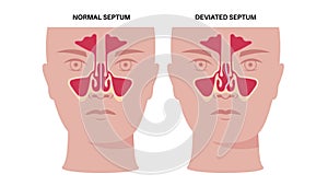 Deviated septum poster