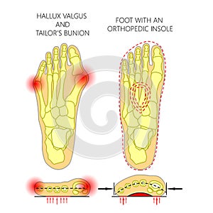 Deviation of the first and the fifth metatarsals transverse flat