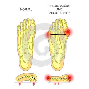 Deviation of the first and the fifth metatarsals transverse flat