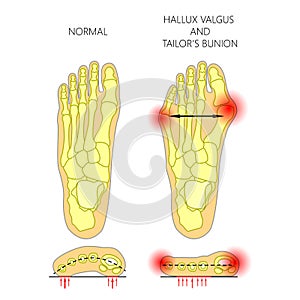 Deviation of the first and the fifth metatarsals transverse flat photo