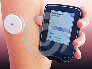 Device for continuous glucose monitoring of  blood sugar levels Ã¢â¬â CGM photo