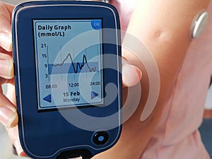 Device for continuously glucose monitoring in  blood â€“ CGM. Diabetes type 1. Insulin depend