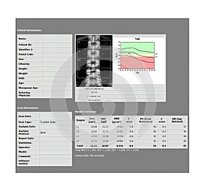 DEXA densitometry report of lumbar spine scan.