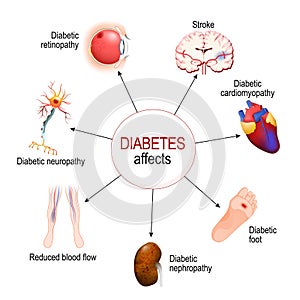 Diabetes Affects. Complications of diabetes mellitus