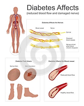 Diabetes affects the nerves and vessels.