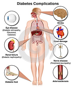 Diabetes complications and diseases medical 3d  illustration on white background