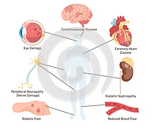 Diabetes disease complications affected human organs isolated medical set on white background