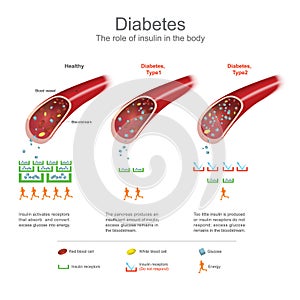 Diabetes. Health care info graphic. Vector design.