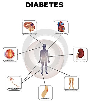 Diabetes Mellitus