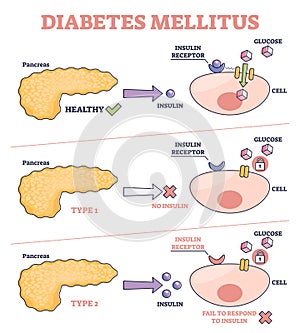 Diabetes mellitus as high blood sugar and metabolic illness outline diagram