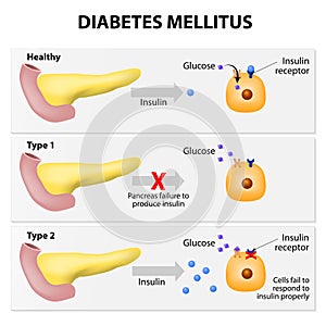 Diabetes mellitus photo