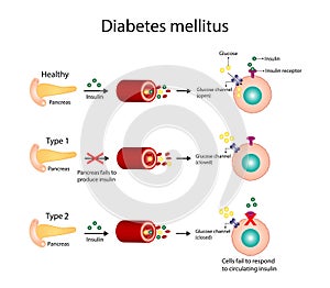 Diabetes mellitus type 1, pancreas\'s failure to produce insulin, type 2, cells fail to respond to insulin