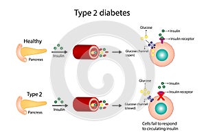 Diabetes mellitus type 2, cells fail to respond to insulin, Insulin resistance. high blood glucose levels.