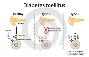 Diabetes mellitus type 1, pancreas\'s failure to produce enough insulin and type 2, insulin resistance. Vector illustration photo