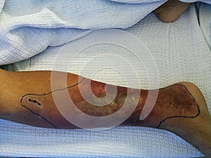 A diabetes patient resting on bed and with the leg swelling and redness symptoms. photo