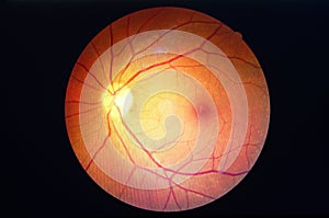 Diabetes retinopathy.