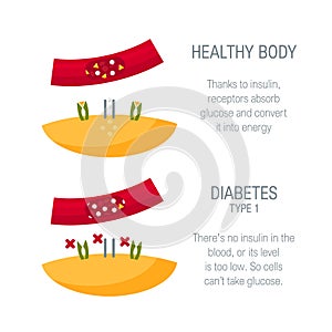 Diabetes type 1 concept in flat style, vector