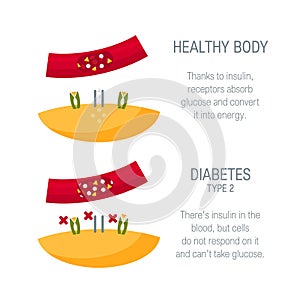 Diabetes type 2 concept in flat style, vector