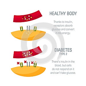 Diabetes type 2 concept in flat style, vector photo