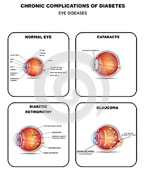 Diabetic Eye Diseases diagram photo