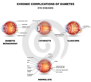 Diabetic Eye Diseases photo