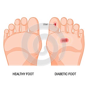 Diabetic foot