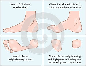 Diabetic foot photo