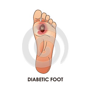 Diabetic Foot. Defeat, ulcer, skin sores on foot photo