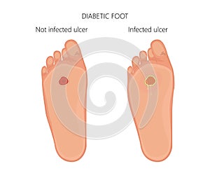 Diabetic foot with infected ulcer