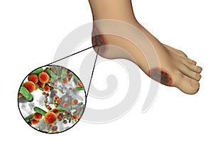 Diabetic foot infection with close-up view of bacteria