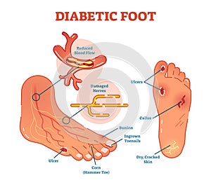 Diabetic foot medical vector illustration scheme.