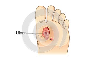 Diabetic Foot Pain and Ulcers. photo