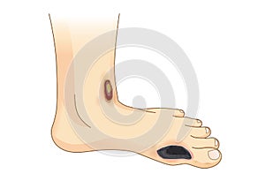 Diabetic Foot Pain and Ulcers. photo