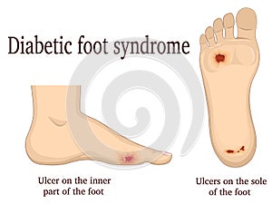 Diabetic foot syndrome photo