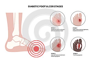 Diabetic Foot Ulcers photo