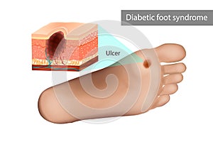 Diabetic foot syndrome ulcer. Destruction of deep tissues of the foot