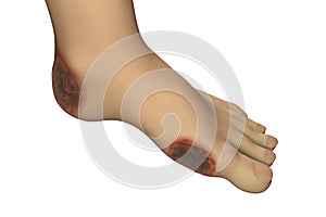 Diabetic foot ulcer photo