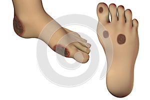 Diabetic foot ulcer photo