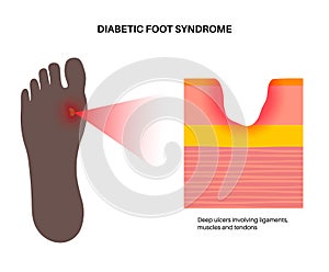 Diabetic Foot Ulcers