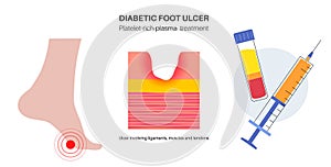 Diabetic Foot Ulcers