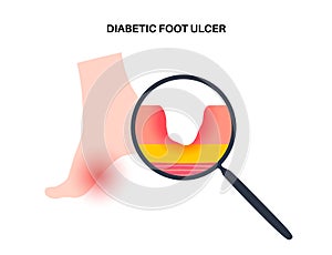 Diabetic Foot Ulcers photo