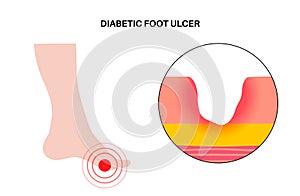 Diabetic Foot Ulcers