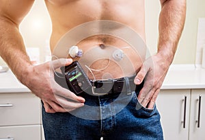 Diabetic man with an insulin pump connected in his abdomen