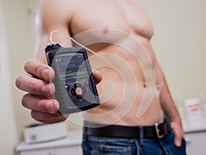 Diabetic man with an insulin pump connected in his abdomen